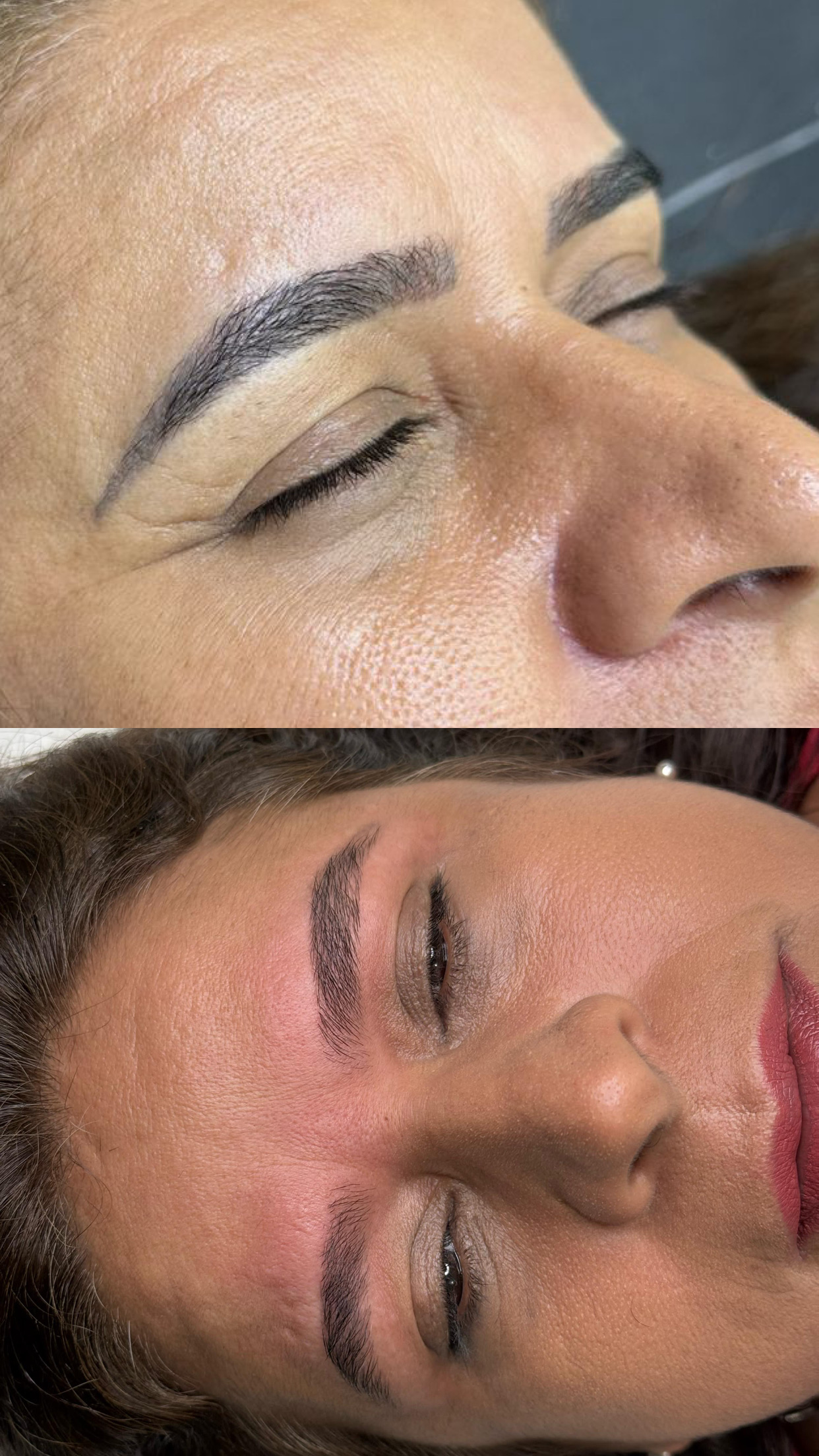 Antes e depois de remoção de micropigmentação a laser